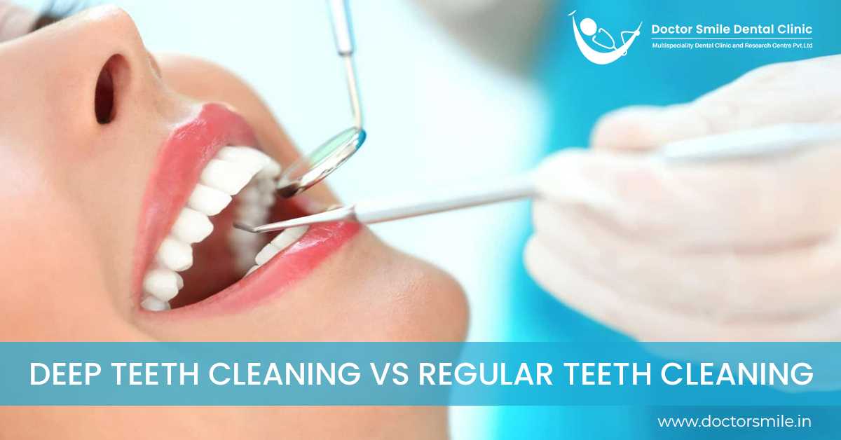 Deep Teeth Cleaning Vs. Regular Teeth Cleaning