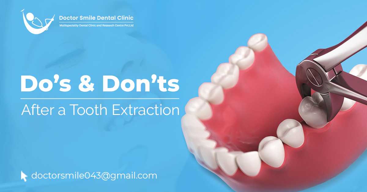 The Dos And Don’ts After A Tooth Extraction