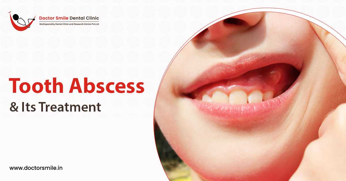 Your Best Dentist To Treat Abscessed Tooth