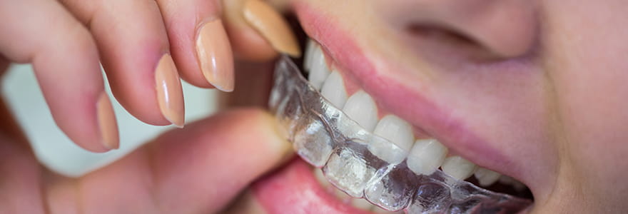 Invisible Braces/Aligners :